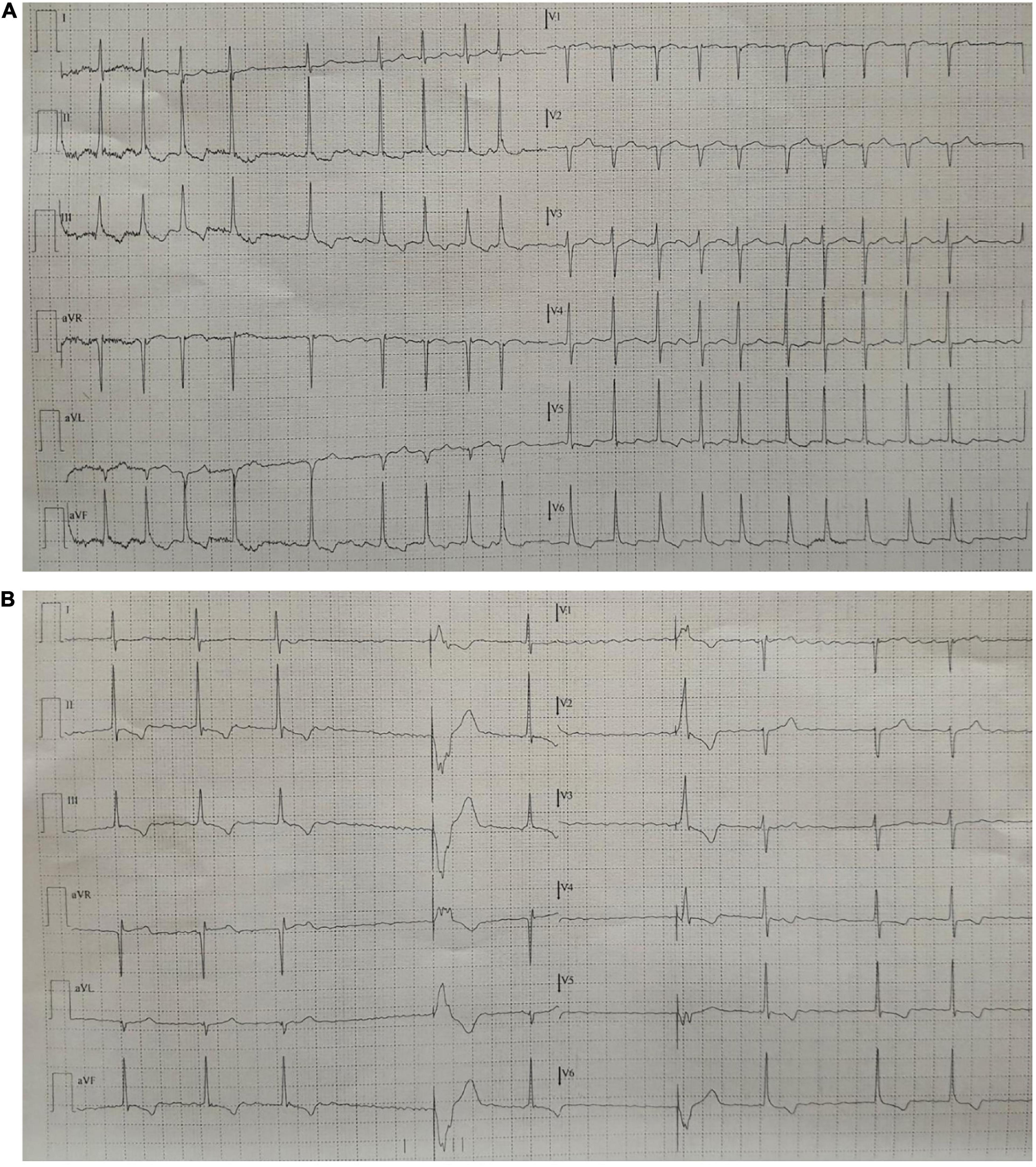 Case report: An unusual case of phrenic nerve stimulation in a patient with single chamber implantable cardioverter defibrillator